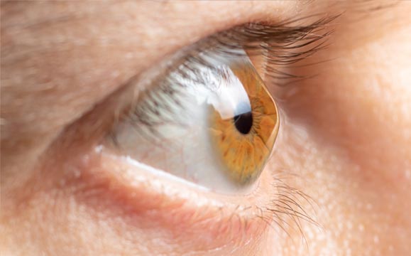Close up of eye with keratoconus